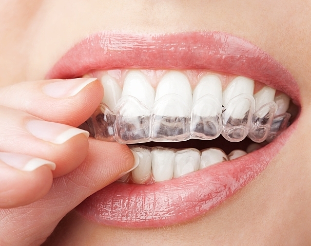 teeth with whitening tray